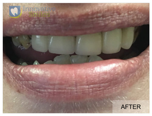 closeup on mouth after veneers