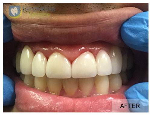 closeup on mouth after crown