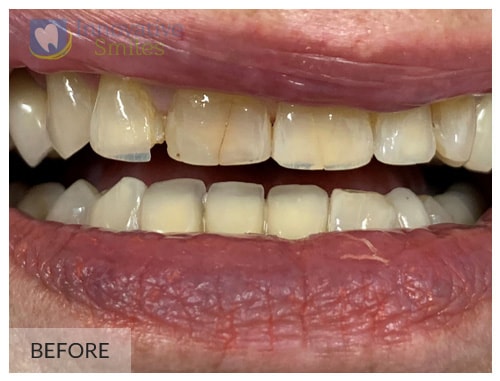 dental patient before receiving veneers