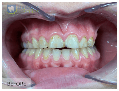 closeup on mouth before upper anterior porcelain veneers