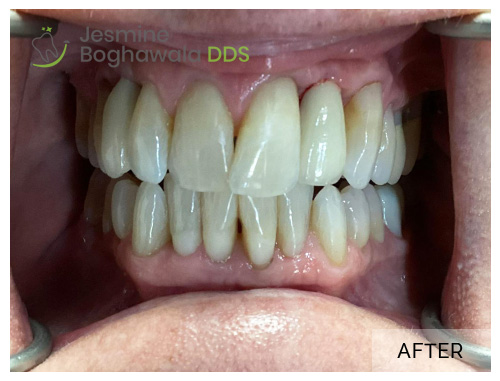 Dental_Implants_patient_after_image_01