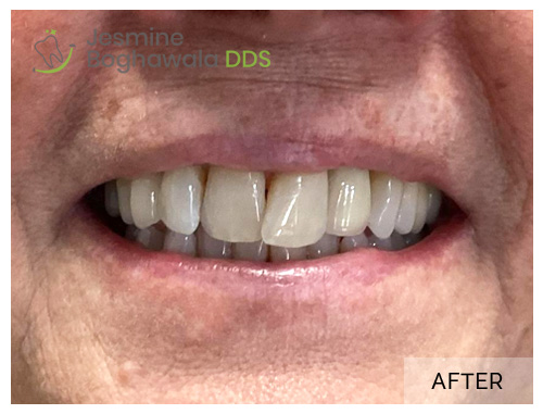 Dental_Implants_patient_after_image_02